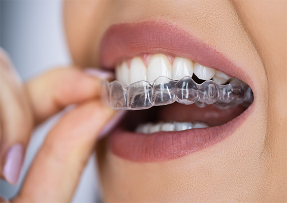 Clear aligners treatment Mumbai
