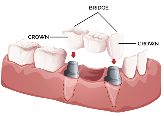 Crowns and bridges treatment in borivali mumbai