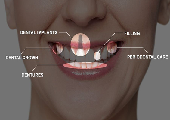 Full mouth rehabilitation treatment in Borivali Mumbai