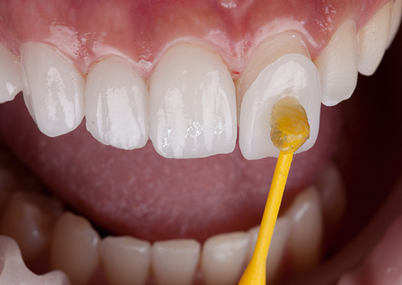 laminates and veeners services in borivali west mumbai