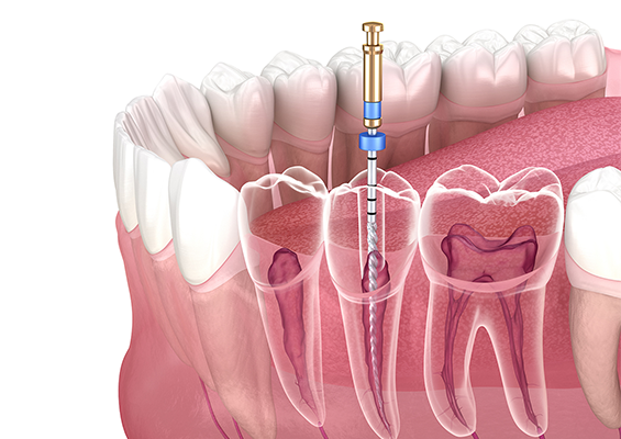 Best root canal treatment in borivali Mumbai