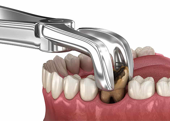 best surgical extraction facility in borivali mumbai