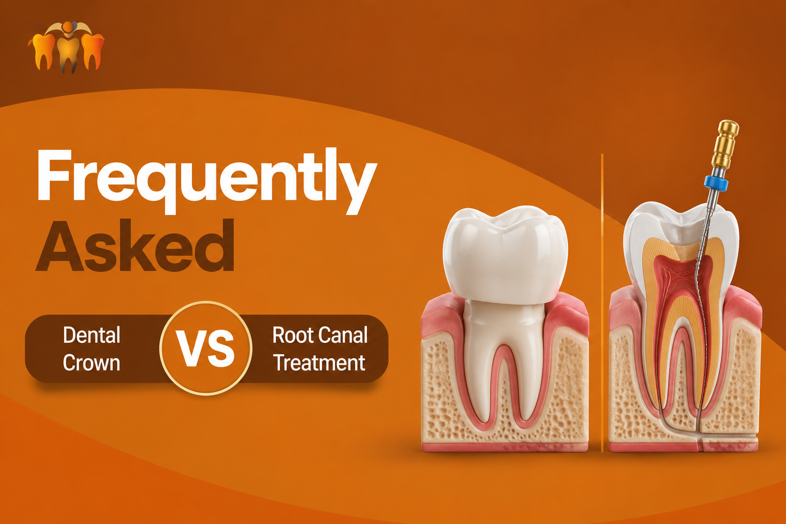 Dental Crown vs Root Canal Treatment: Frequently Asked Questions